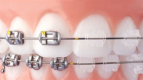 brackets metalicos o porcelana|Brackets Cerámicos Vs Metálicos: 7 Diferencias .